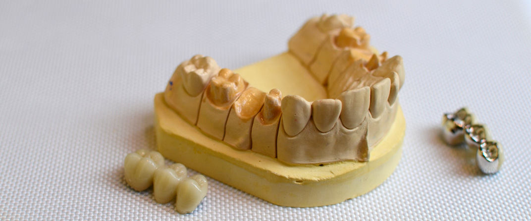 Zahnersatz Modell Zahnarztpraxis Mruk