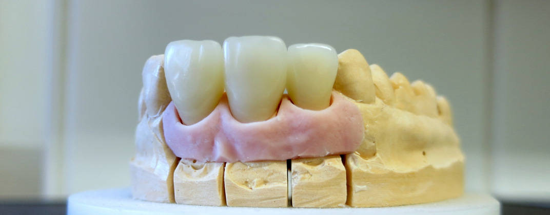 Zahnersatz - Implantate und Prothetik